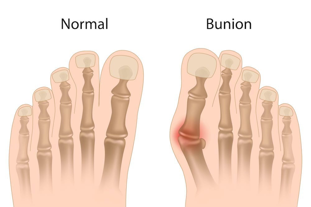 Bunions & Hammertoes