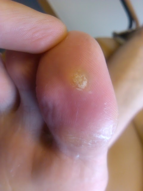 Plantar Warts