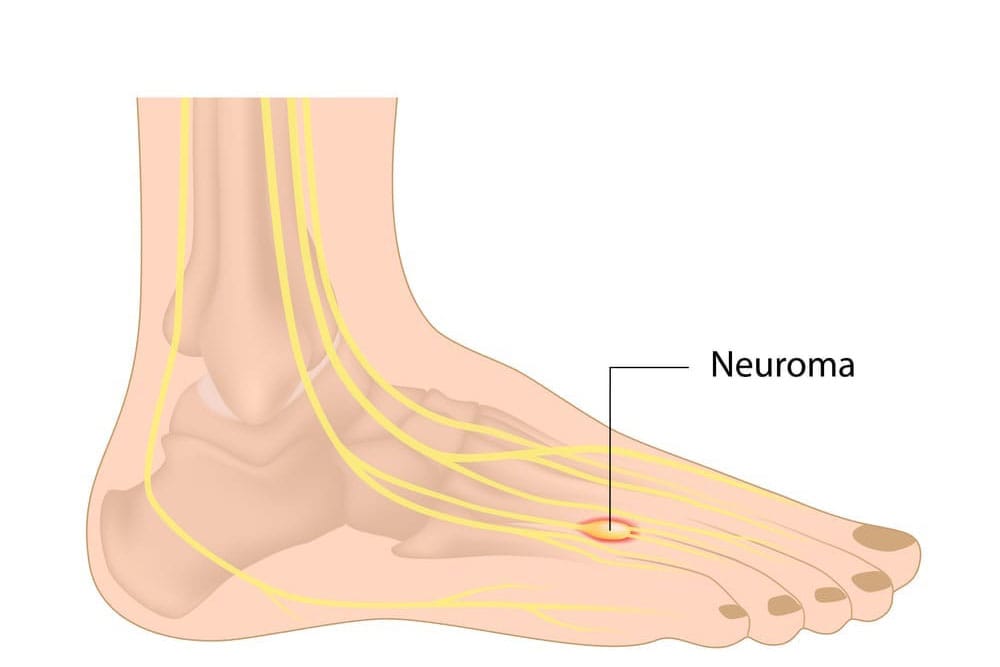 Neuromas